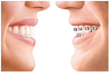 Orthodontics, Invisalign, dentist, cosmetics, implants, orthodontics, lawrenceville, Georgia, 30043