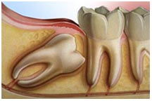 Oral surgery, wisdom teeth, extraction, dentist, cosmetics, implants, orthodontics, lawrenceville, Georgia, 30043
